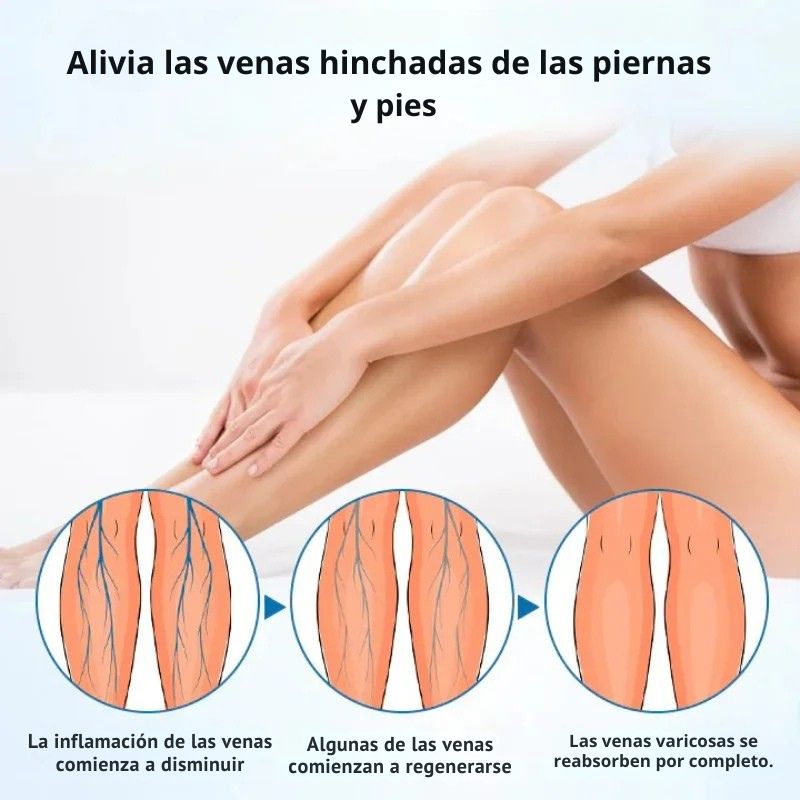 Spray anti-varices express 2X1: resultados visibles en 7 días sin cirugía