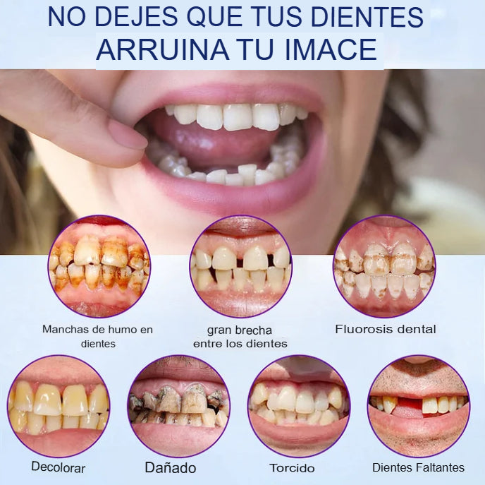 Carillas dentales EverSmile™ Renueva tu Sonrisa sin Visitar al Dentista🦷