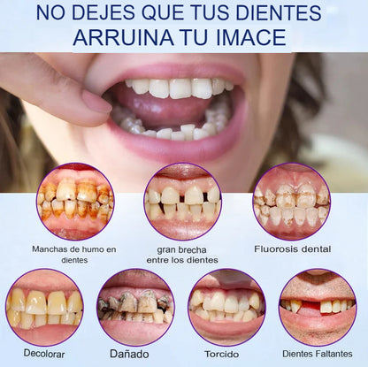 Carillas dentales EverSmile™ Renueva tu Sonrisa sin Visitar al Dentista🦷