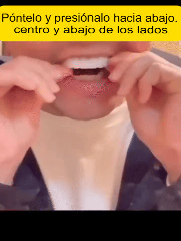 Carillas dentales EverSmile™ Renueva tu Sonrisa sin Visitar al Dentista🦷