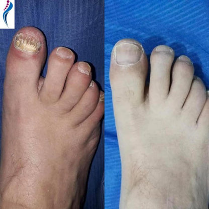 Onyxa™- LASER PARA UÑAS DE LOS PIES