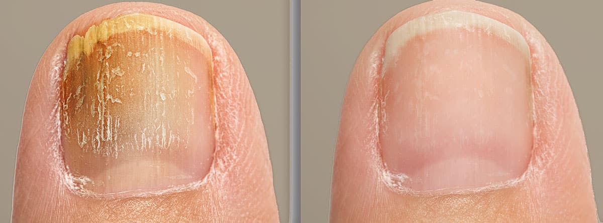 Onyxa™- LASER PARA UÑAS DE LOS PIES