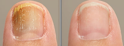 Onyxa™- LASER PARA UÑAS DE LOS PIES