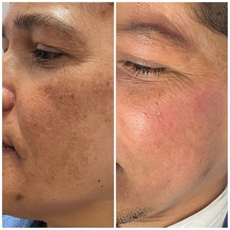SAAM™ || CUIDADO FACIAL PARA UNA PIEL IMPECABLE + CREMA ANTI ESTRIAS DE REGALO🎁