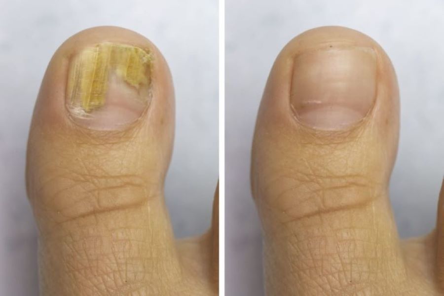 Onyxa™- LASER PARA UÑAS DE LOS PIES