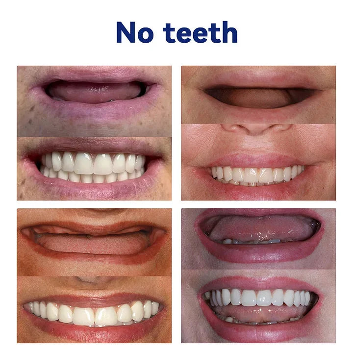 Carillas dentales EverSmile™ Renueva tu Sonrisa sin Visitar al Dentista🦷