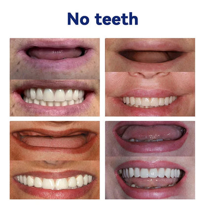 Carillas dentales EverSmile™ Renueva tu Sonrisa sin Visitar al Dentista🦷